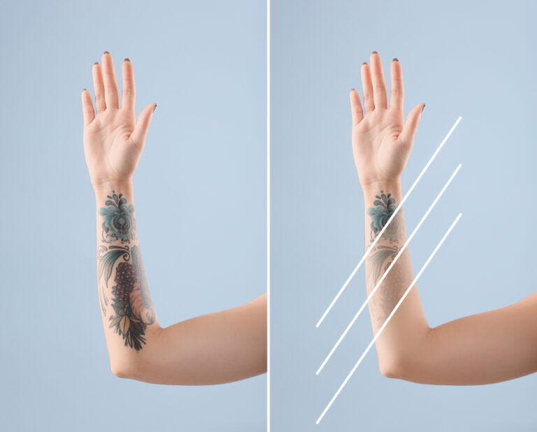 Understanding The Tattoo Removal Process Laser Eraser