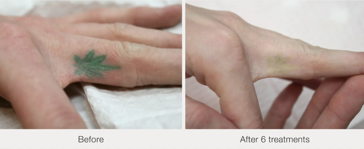 Before and after laser tattoo removal result 2 — Laser Eraser, NJ