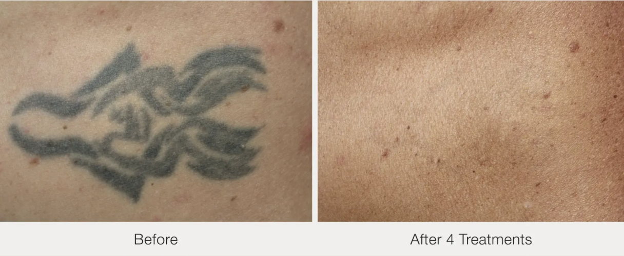 Before and after laser tattoo removal at Laser Eraser in Clark, NJ