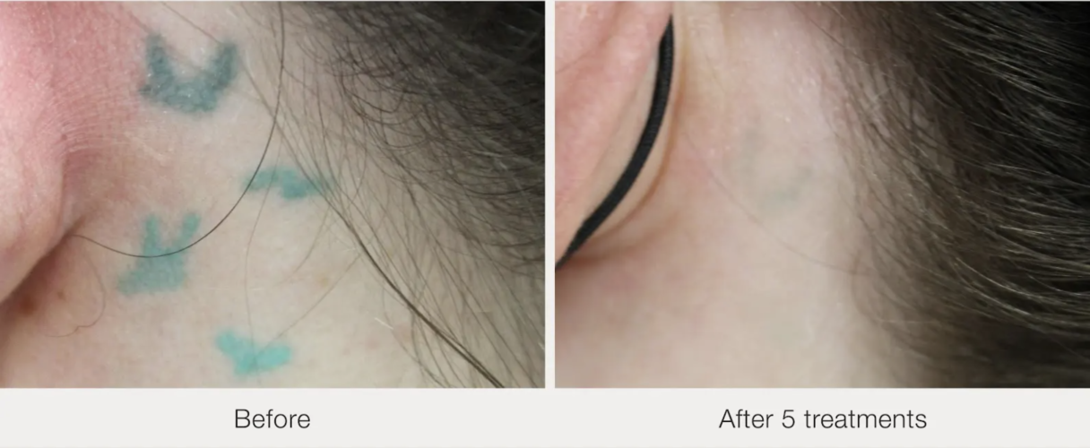 Before and after laser tattoo removal result 4 — Laser Eraser, NJ