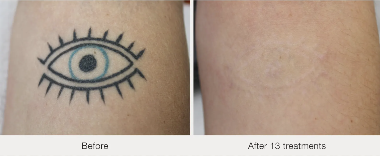 Before and after laser tattoo removal result 5 — Laser Eraser, NJ