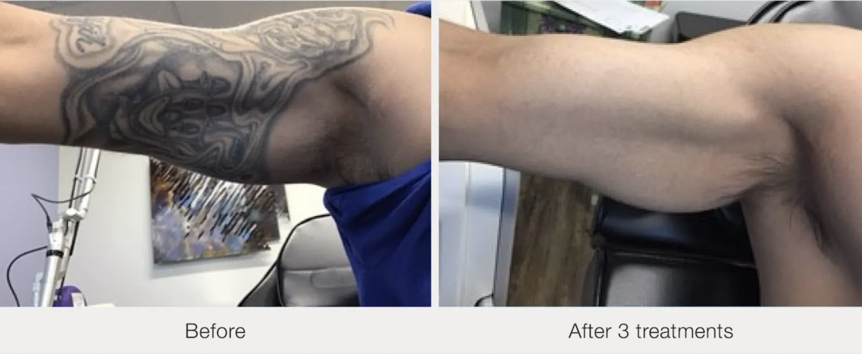 Before and after laser tattoo removal result 6 — Laser Eraser, NJ