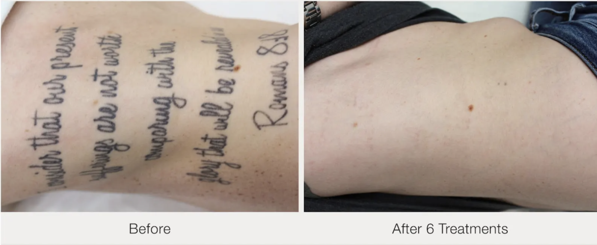 Before and after laser tattoo removal result 7 — Laser Eraser, NJ