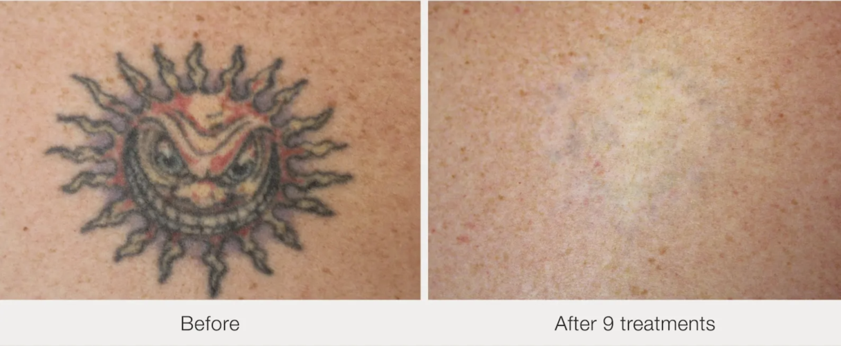 Laser Tattoo Removal & Fading