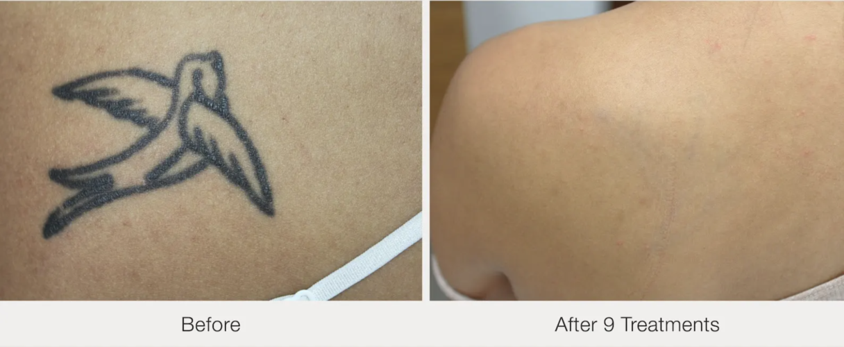 Before and after laser tattoo removal result 9 — Laser Eraser, NJ