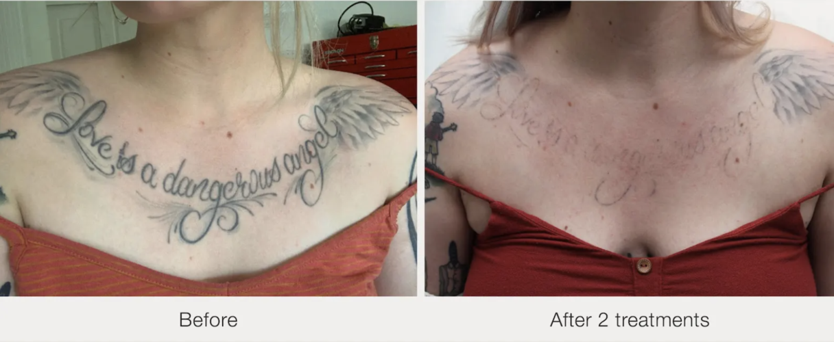 Before and after laser tattoo removal result 10 — Laser Eraser, NJ