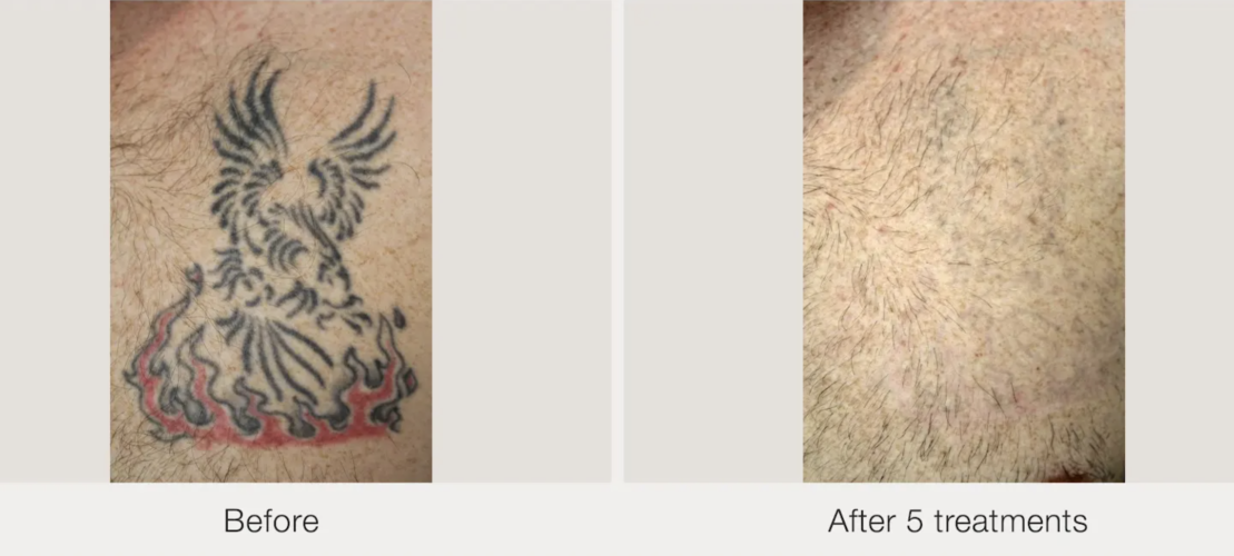 Before and after laser tattoo removal result 11 — Laser Eraser, NJ