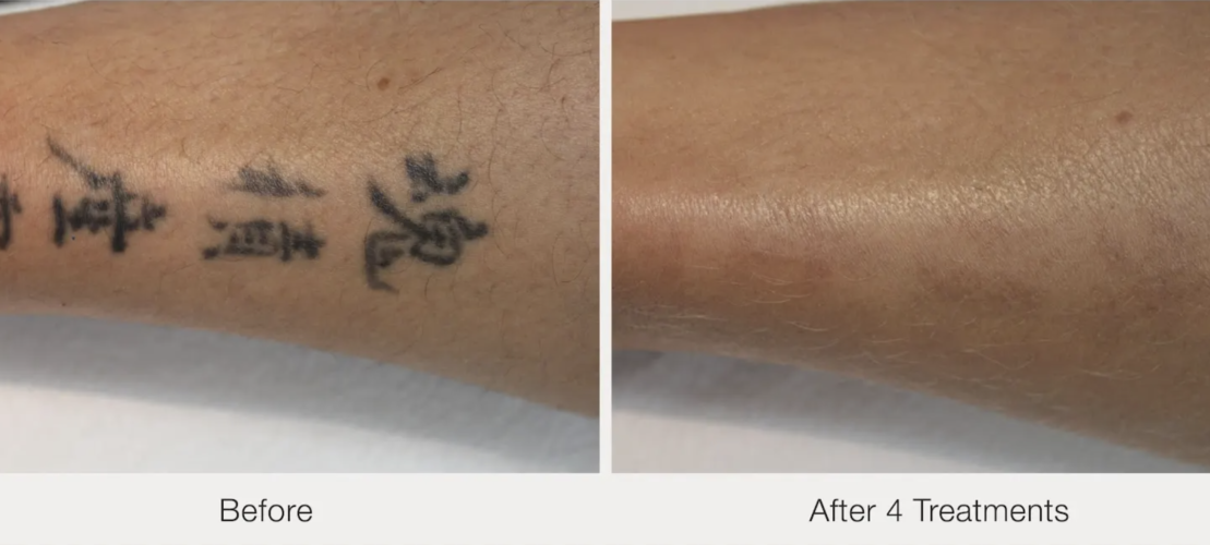 Before and after laser tattoo removal result 12 — Laser Eraser, NJ
