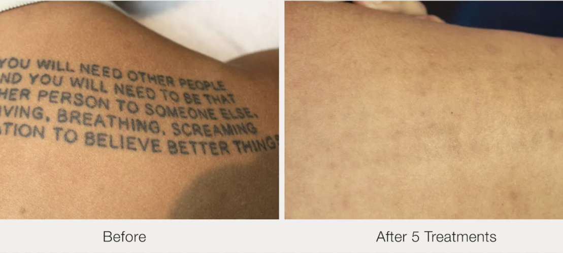Before and after laser tattoo removal result 13 — Laser Eraser, NJ
