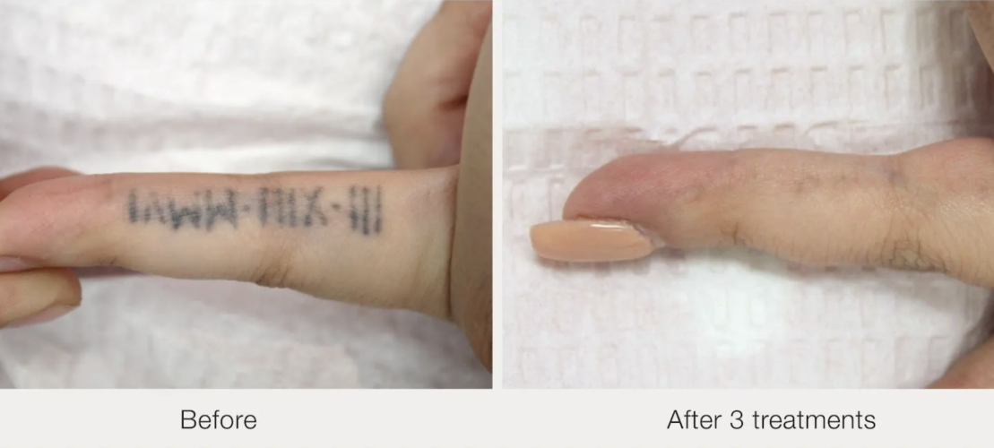 Before and after laser tattoo removal result 14 — Laser Eraser, NJ