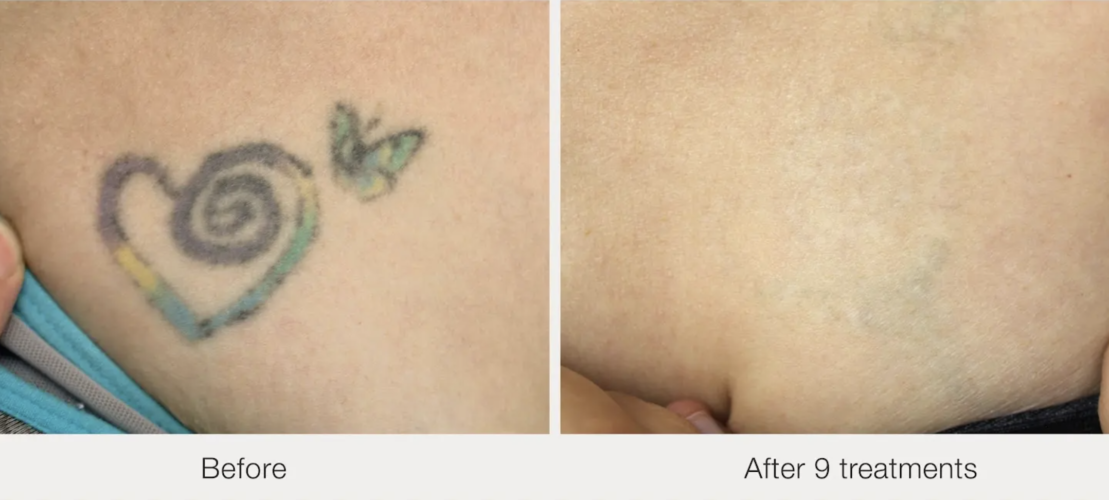 Before and after laser tattoo removal result 15 — Laser Eraser, NJ