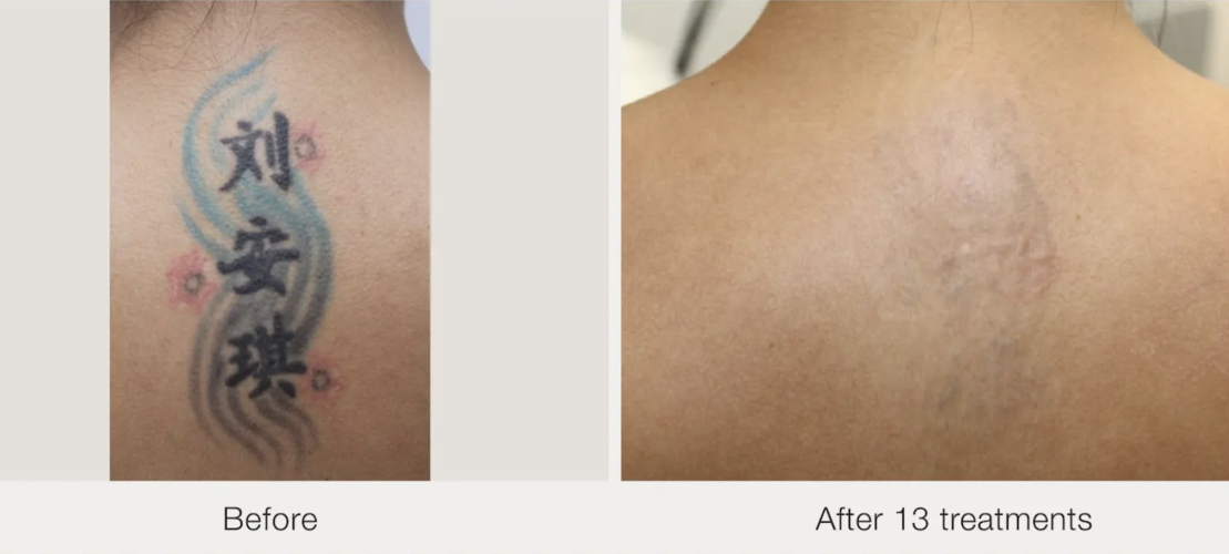 Before and after laser tattoo removal result 16 — Laser Eraser, NJ