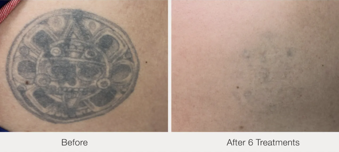 Before and after laser tattoo removal result 17 — Laser Eraser, NJ