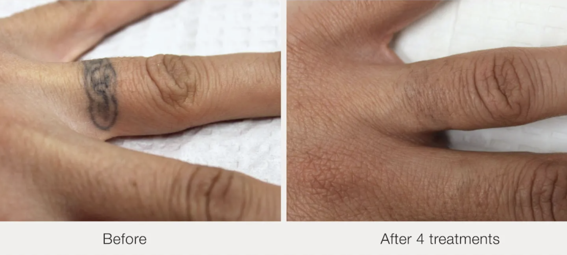 Before and after laser tattoo removal result 18 — Laser Eraser, NJ