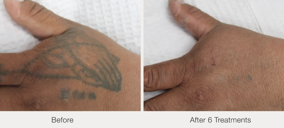Before and after laser tattoo removal result 19 — Laser Eraser, NJ