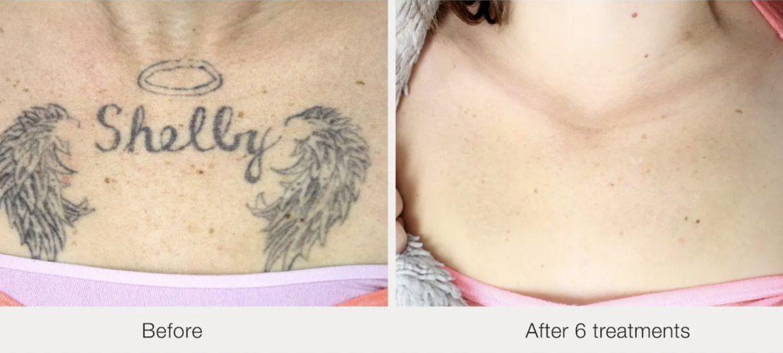 Before and after laser tattoo removal result 20 — Laser Eraser, NJ
