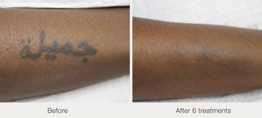 Before and after laser tattoo removal result 21 — Laser Eraser, NJ