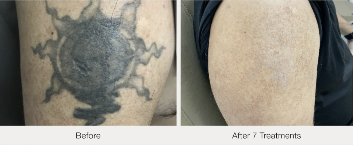 Before and after tattoo removal 1 — Laser Eraser Paramus, NJ