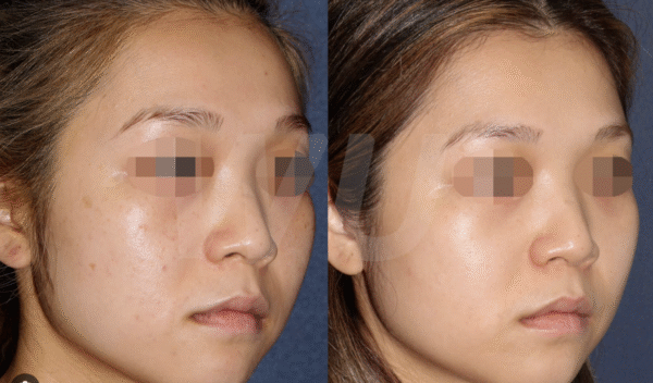 Before and after laser scar treatment result 2 — Laser Eraser, NJ