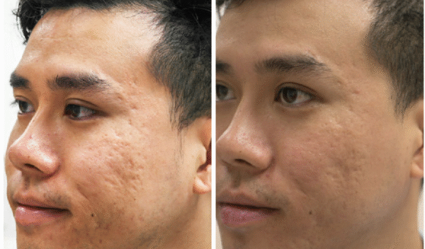 Laser Scar & Pigment Removal