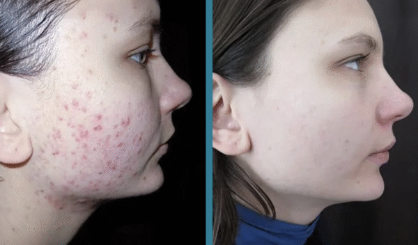 Before and after laser scar treatment result 5 — Laser Eraser, NJ