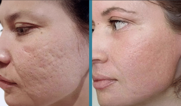 Before and after laser scar treatment result 6 — Laser Eraser, NJ
