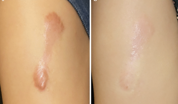Before and after laser scar treatment result 7 — Laser Eraser, NJ