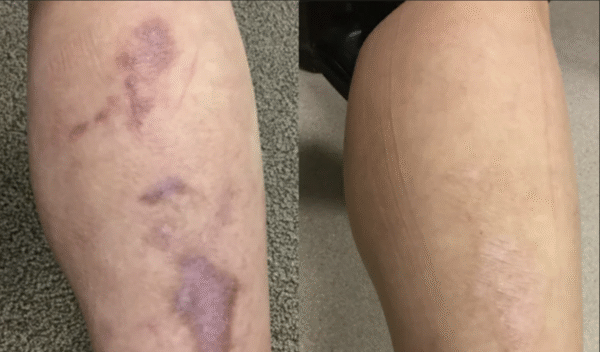 Before and after laser scar treatment result 8 — Laser Eraser, NJ