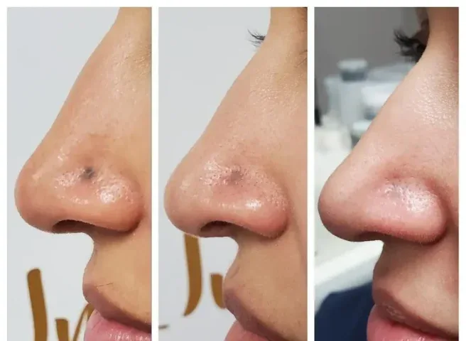 Blue-grey skin discolouration on the nose, shown before and after treatment