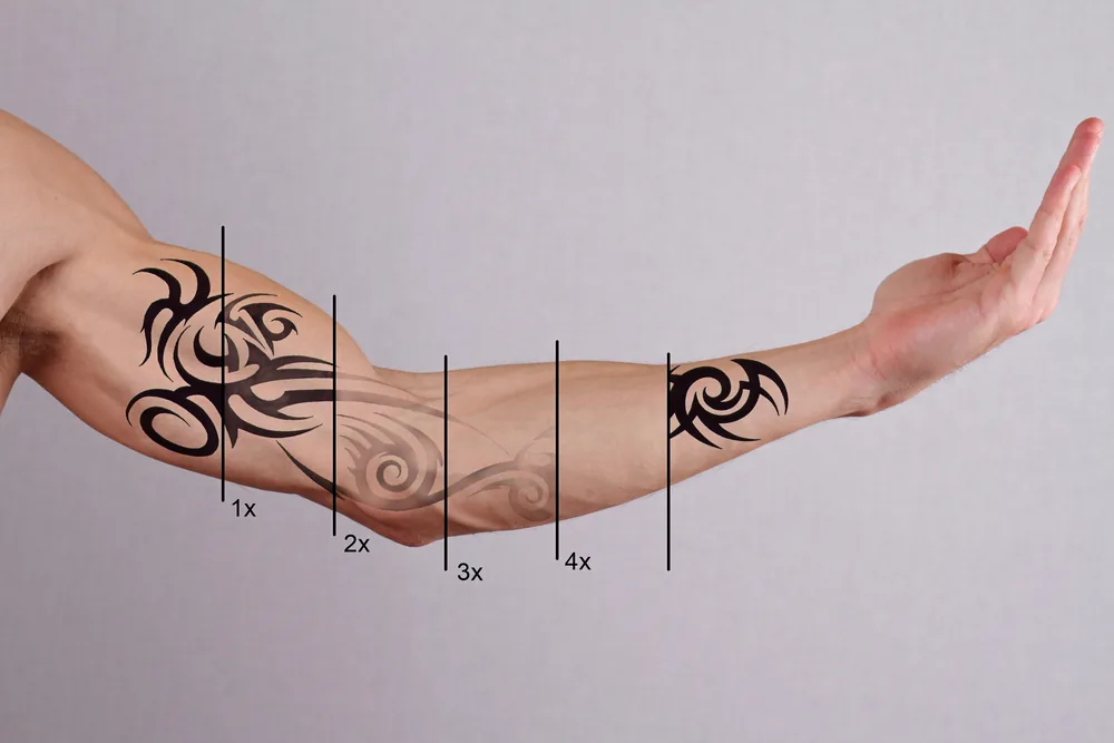 Black tribal forearm tattoo fading across successive laser sessions