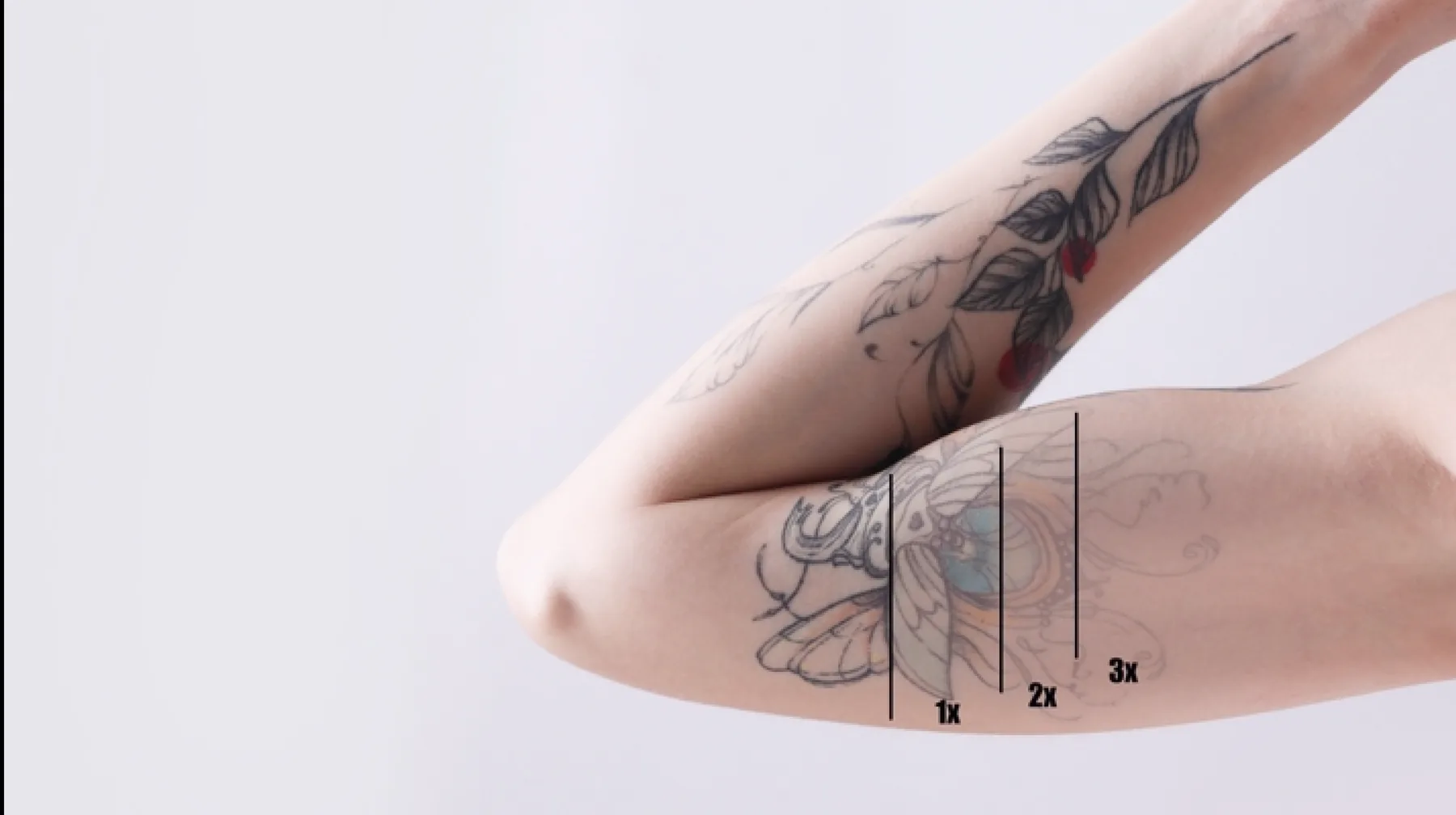 Hand and finger tattoo fading over multiple laser sessions