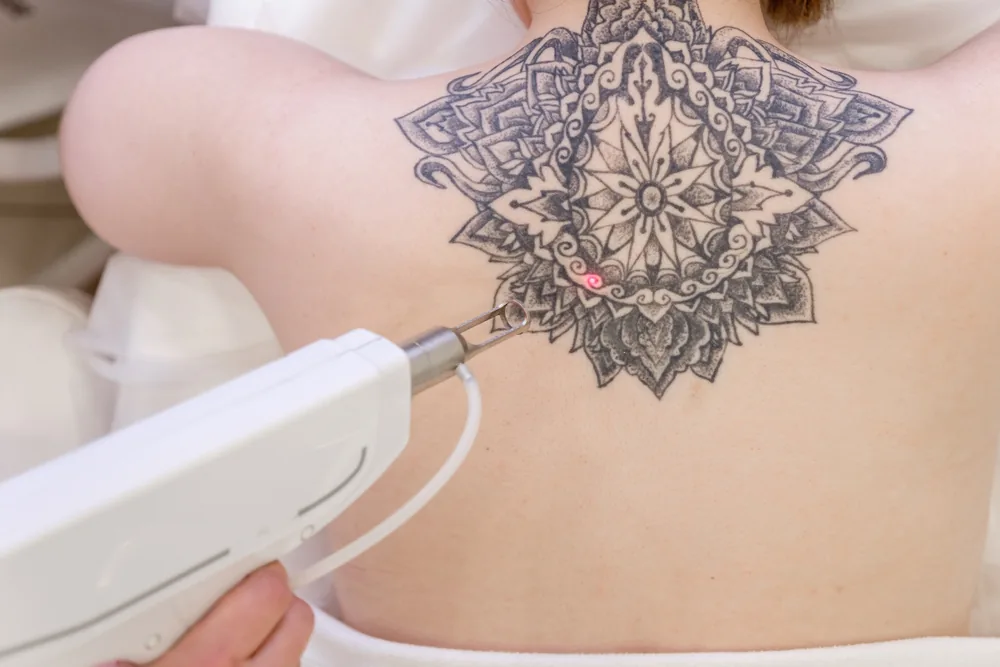 Laser removal of an ornamental upper-back tattoo