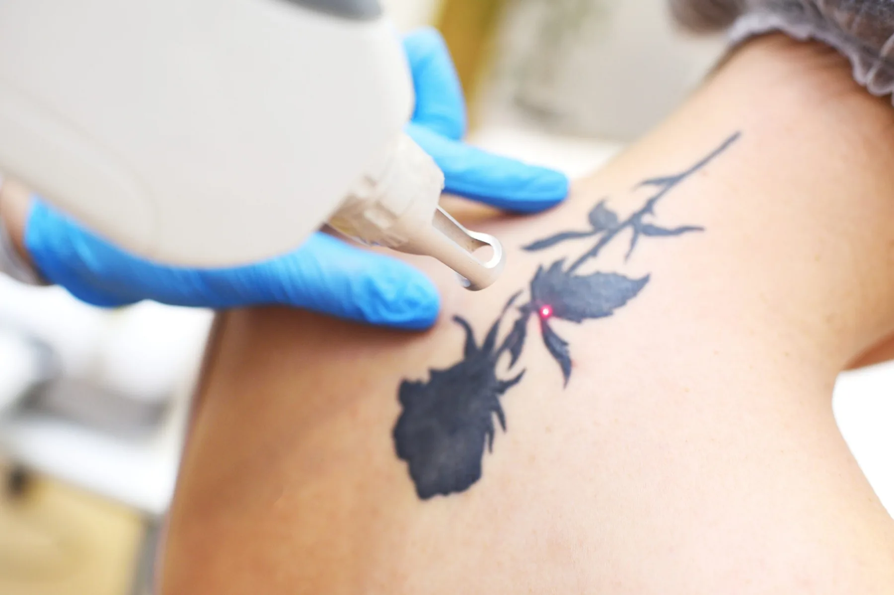 Laser resurfacing being performed along a scar on the back