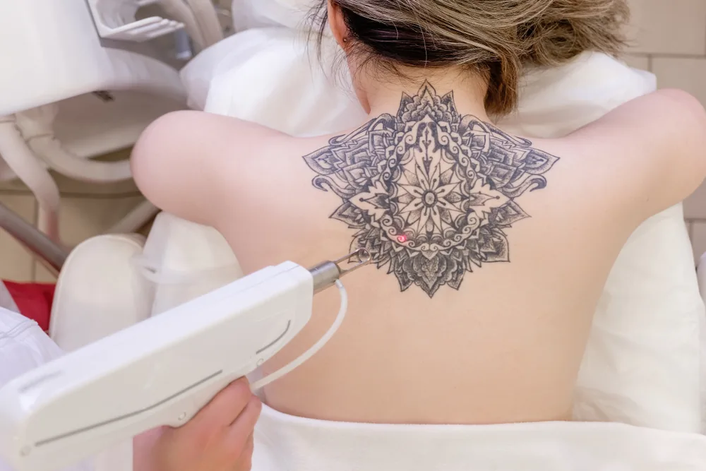 Laser removal of a mandala tattoo on the upper back