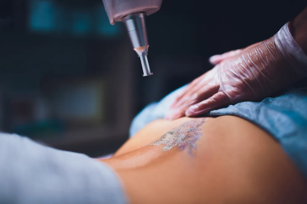 Laser tattoo removal being performed on a shoulder