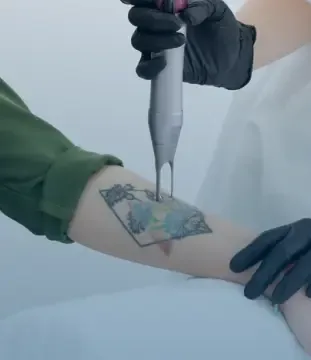 Laser handpiece passing over a tattoo on the forearm