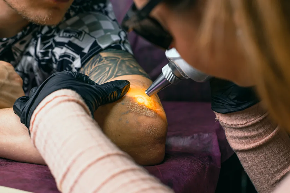 Picosecond laser pulse striking tattoo pigment