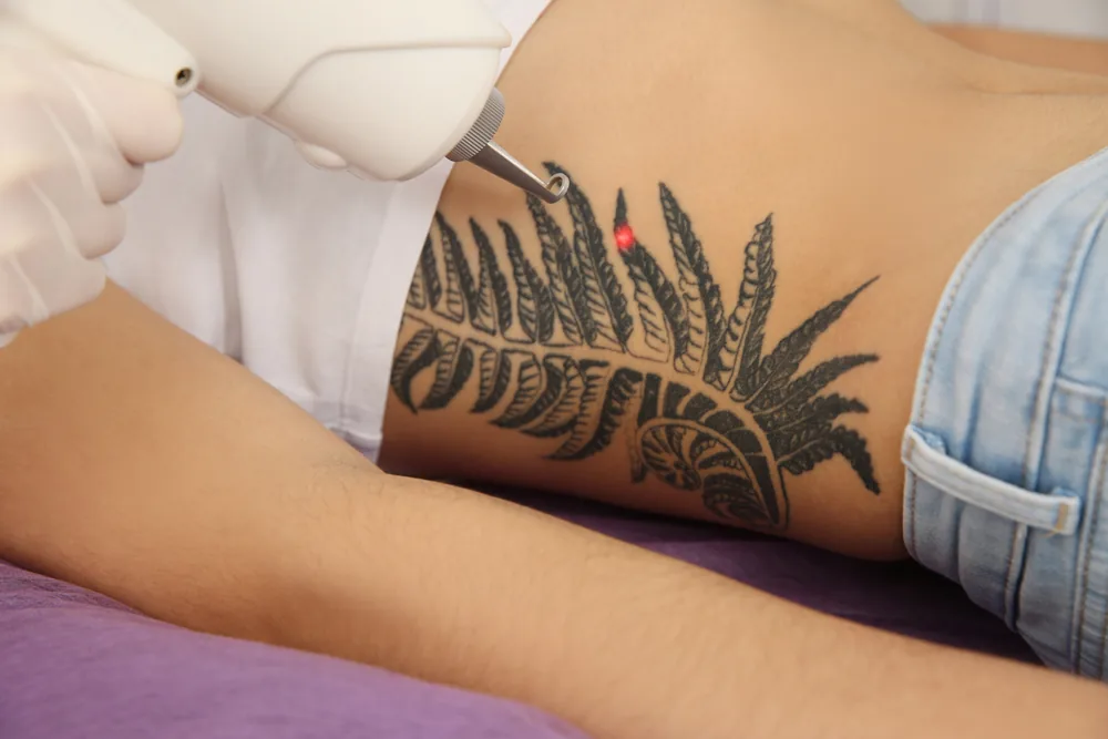 Laser treatment being performed across the hip and lower torso