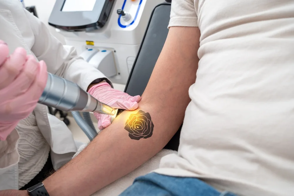 Laser handpiece treating a rose tattoo on the forearm
