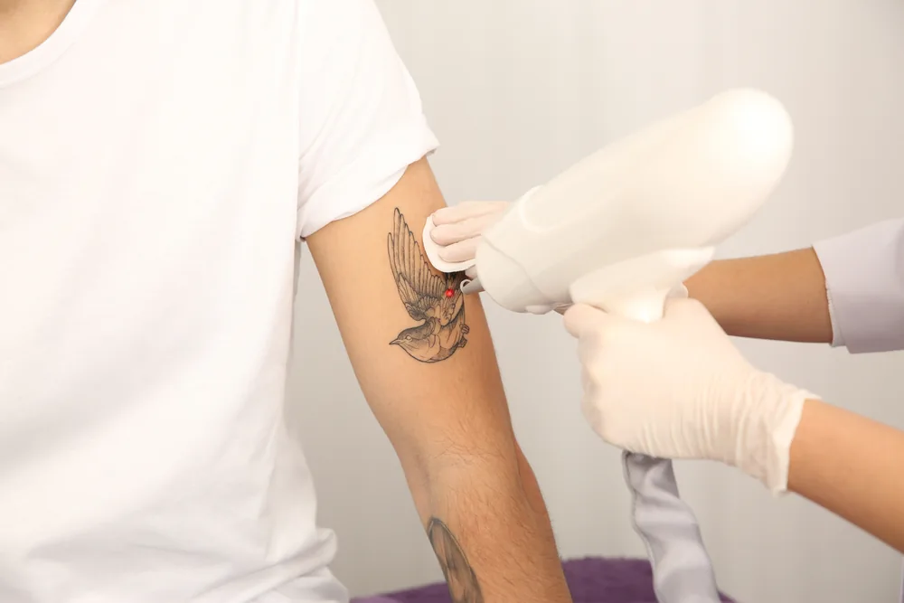 Laser handpiece treating an upper-arm tattoo