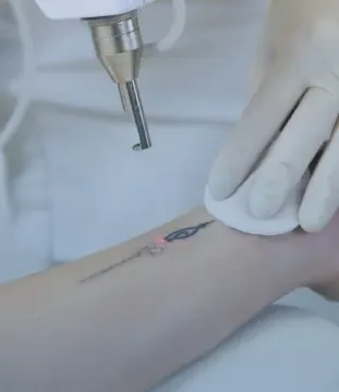 Laser handpiece treating a small wrist tattoo in a clinical setting