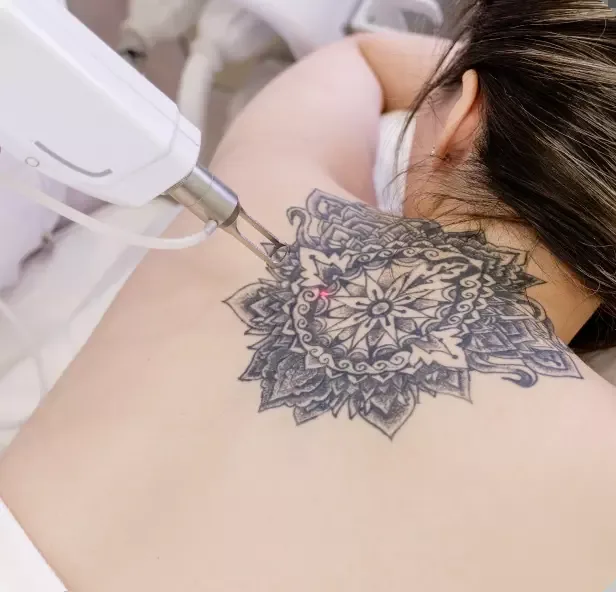 Laser handpiece tracing a mandala tattoo on the upper back