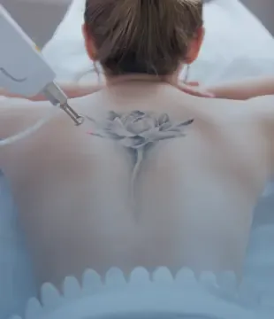 PicoWay laser handpiece treating a lotus tattoo on the back of the neck