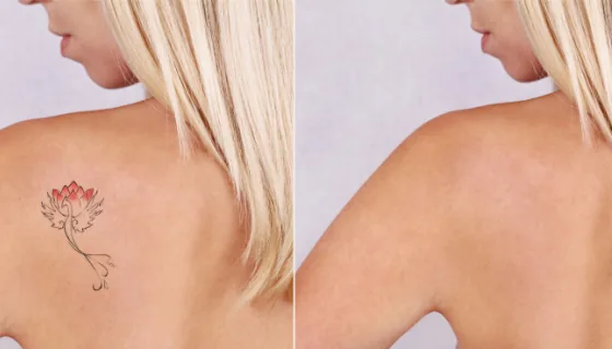 Small red lotus shoulder tattoo before and after laser removal
