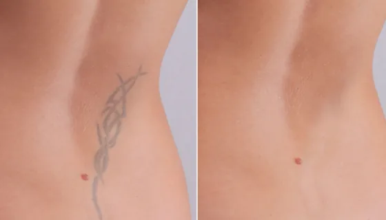 Small fine-line rib tattoo before and after laser removal at Laser Eraser