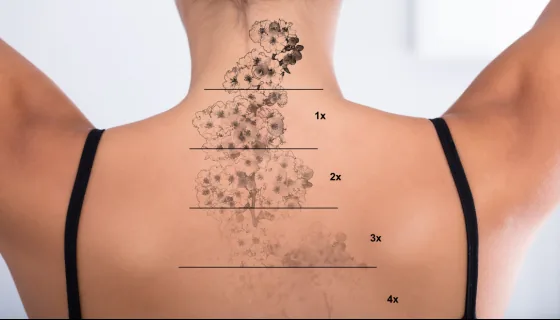 Back tattoo marked to show fading after each laser session