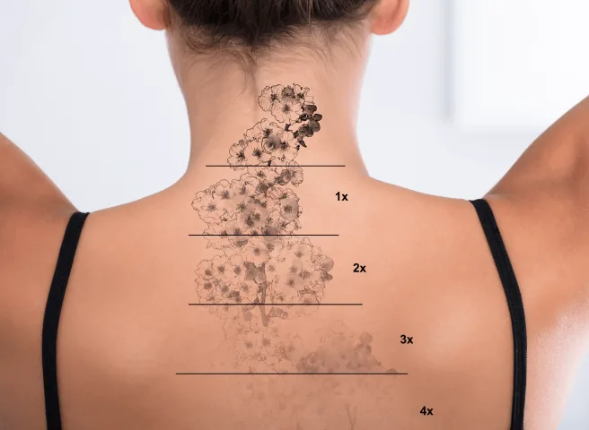 Back tattoo marked to show fading after each laser session
