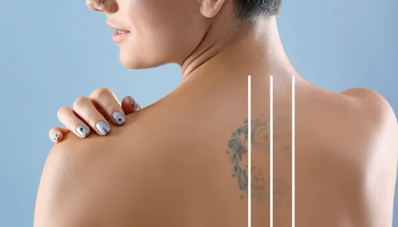 Medium shoulder tattoo before and after laser removal