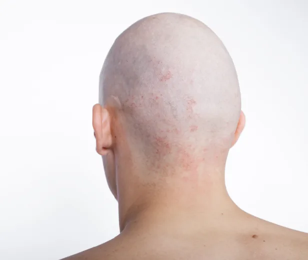 Scalp micropigmentation on the back of a shaved head