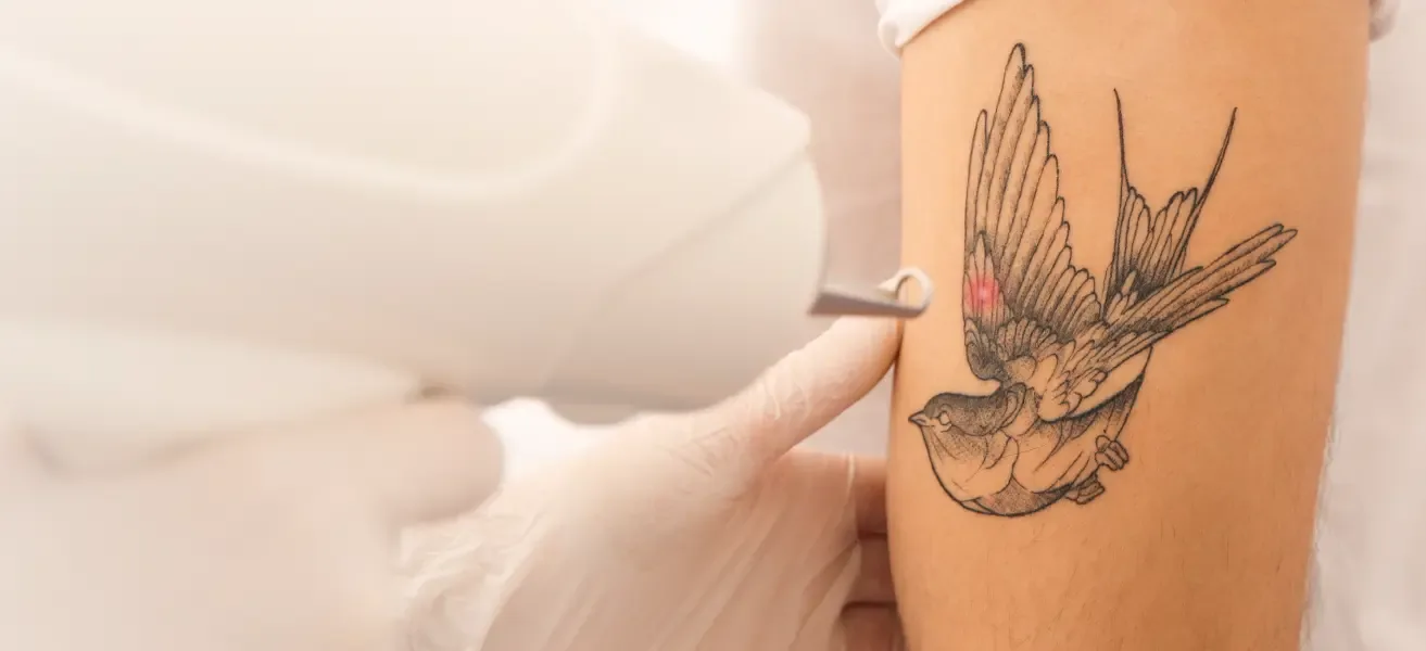 Laser handpiece treating a swallow tattoo on the upper arm